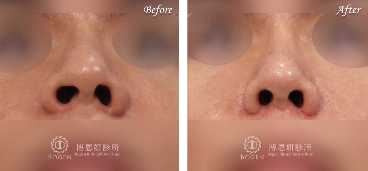 縮鼻翼推薦博恩妍診所張簡醫師縮鼻翼權威
