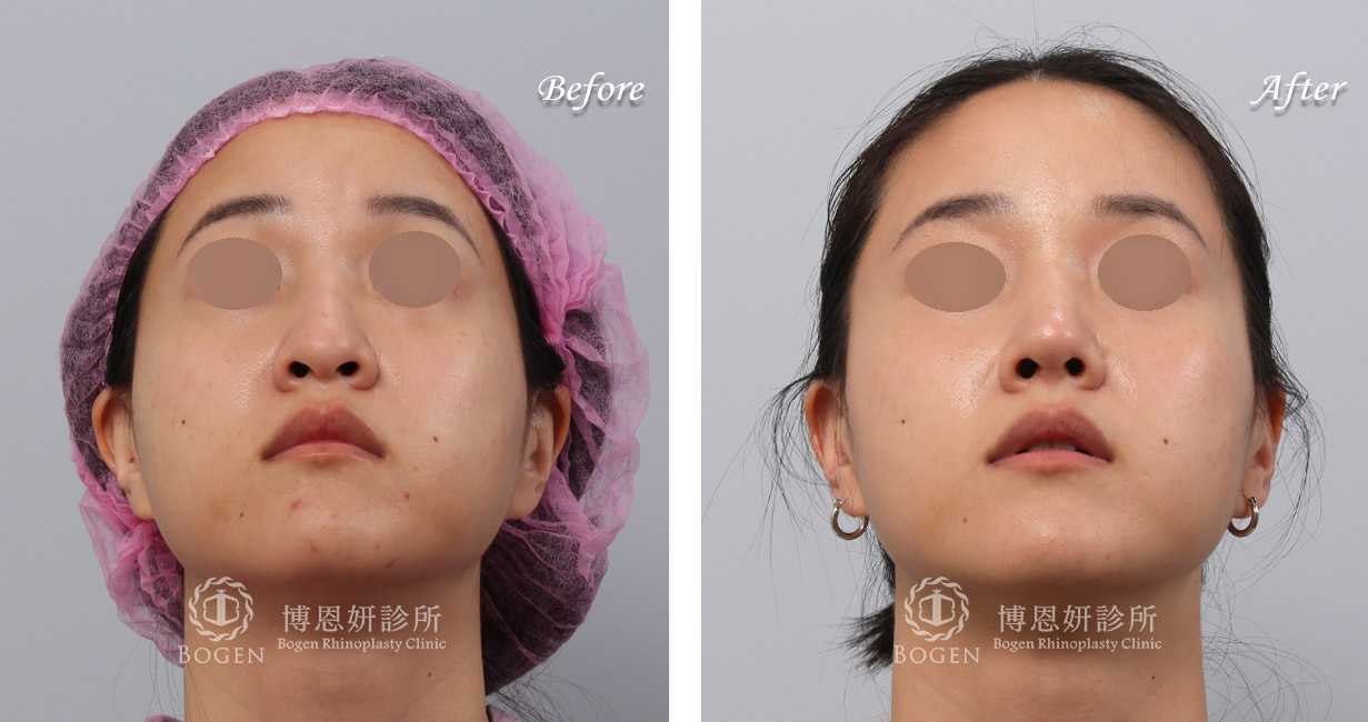 鼻整形術前術後照鼻整形案例15,鼻整形手術推薦博恩妍診所張簡醫師