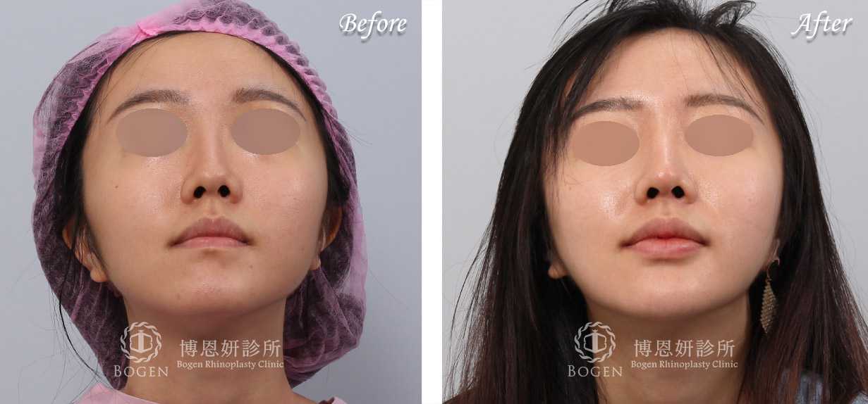 鼻整形術前術後照鼻整形案例21,鼻整形手術推薦博恩妍診所張簡醫師