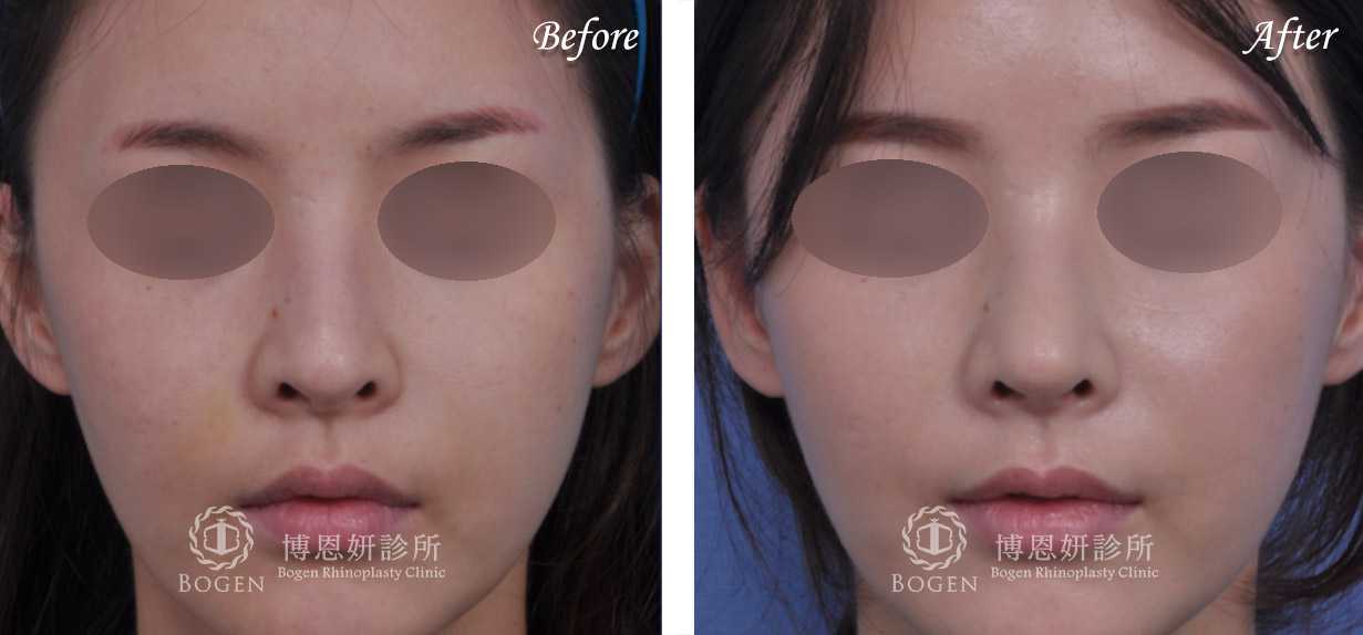 鼻整形術前術後照鼻整形案例14,鼻整形手術推薦博恩妍診所張簡醫師