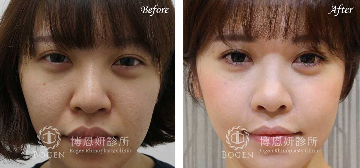 鼻整形術前術後照鼻整形案例06,鼻整形手術推薦博恩妍診所張簡醫師