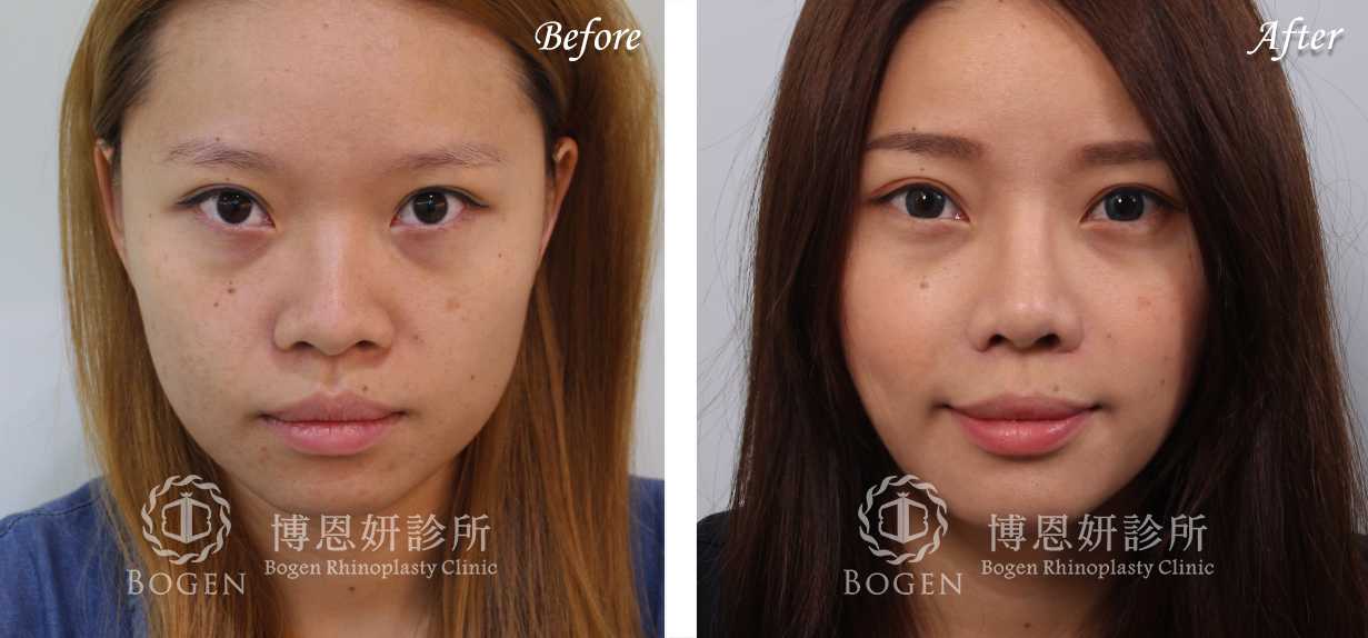 鼻整形術前術後照鼻整形案例9,鼻整形手術推薦博恩妍診所張簡醫師