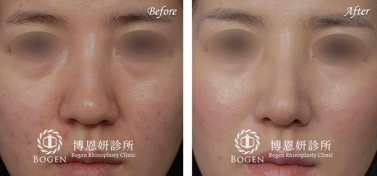 鼻整形術前術後照鼻整形案例13,鼻整形手術推薦博恩妍診所張簡醫師