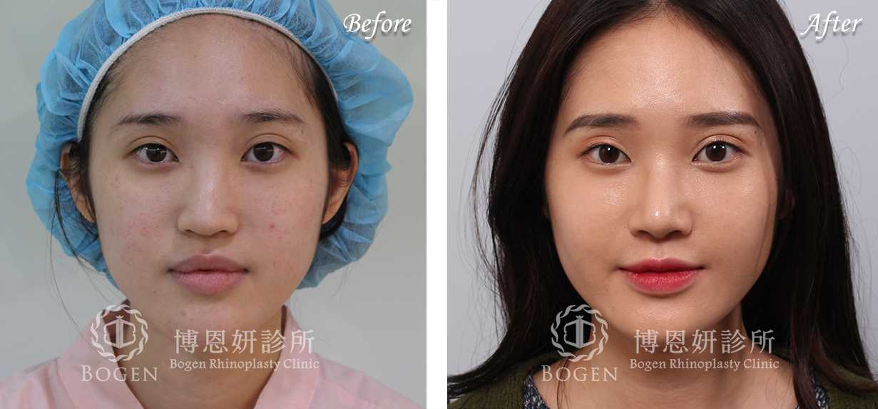 鼻整形術前術後照鼻整形案例16,鼻整形手術推薦博恩妍診所張簡醫師