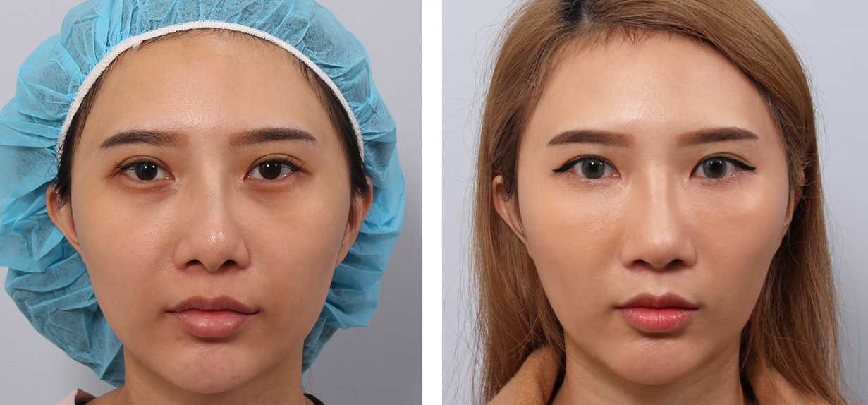 鼻整形術前術後照鼻整形案例17,鼻整形手術推薦博恩妍診所張簡醫師