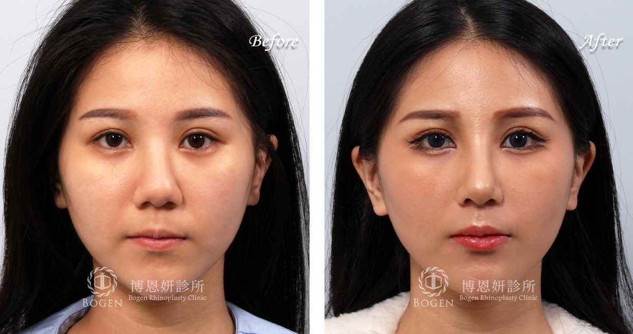 隆鼻分享手術前後照片比對案例,隆鼻手術推薦張簡醫師
