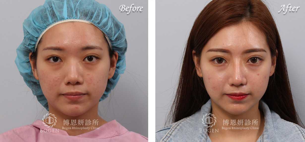 鼻整形術前術後照鼻整形案例19,鼻整形手術推薦博恩妍診所張簡醫師