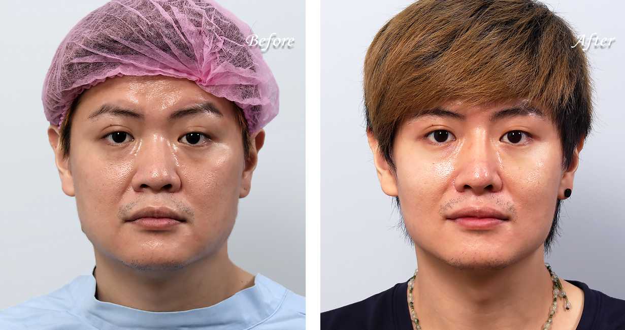 男性鼻整形術前術後照鼻整形案例20,鼻整形手術推薦博恩妍診所張簡醫師