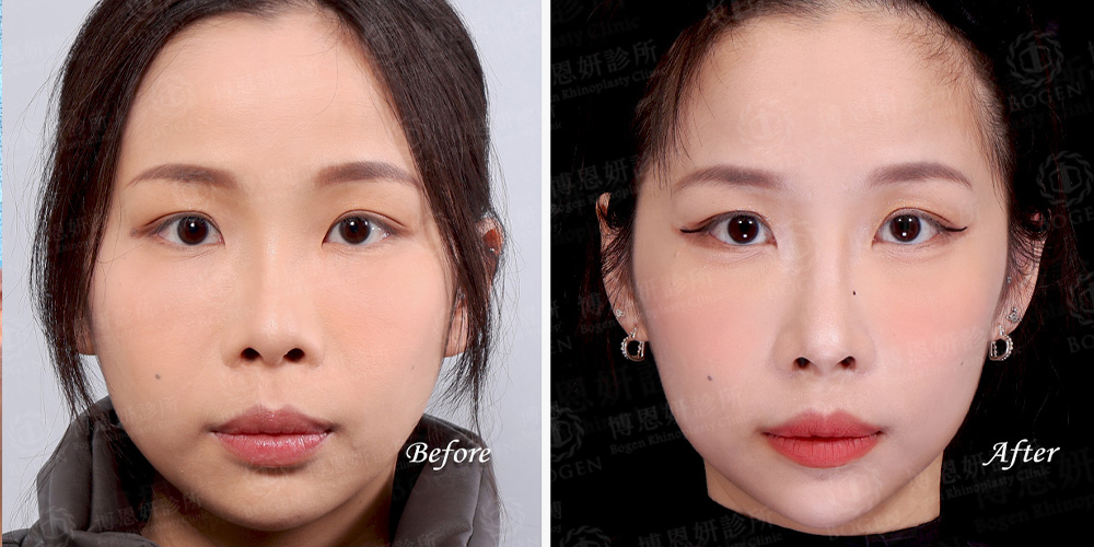 Fitme完形美客製化隆鼻案例三