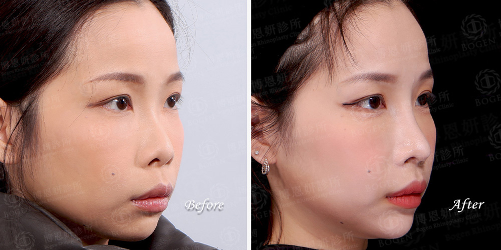 Fitme完形美客製化隆鼻案例三