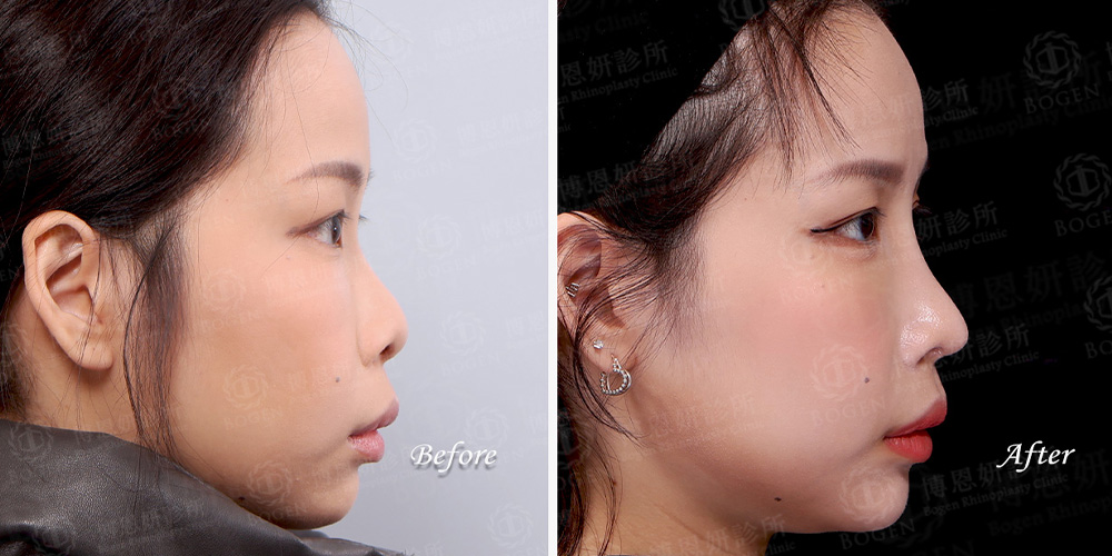 Fitme完形美客製化隆鼻案例三