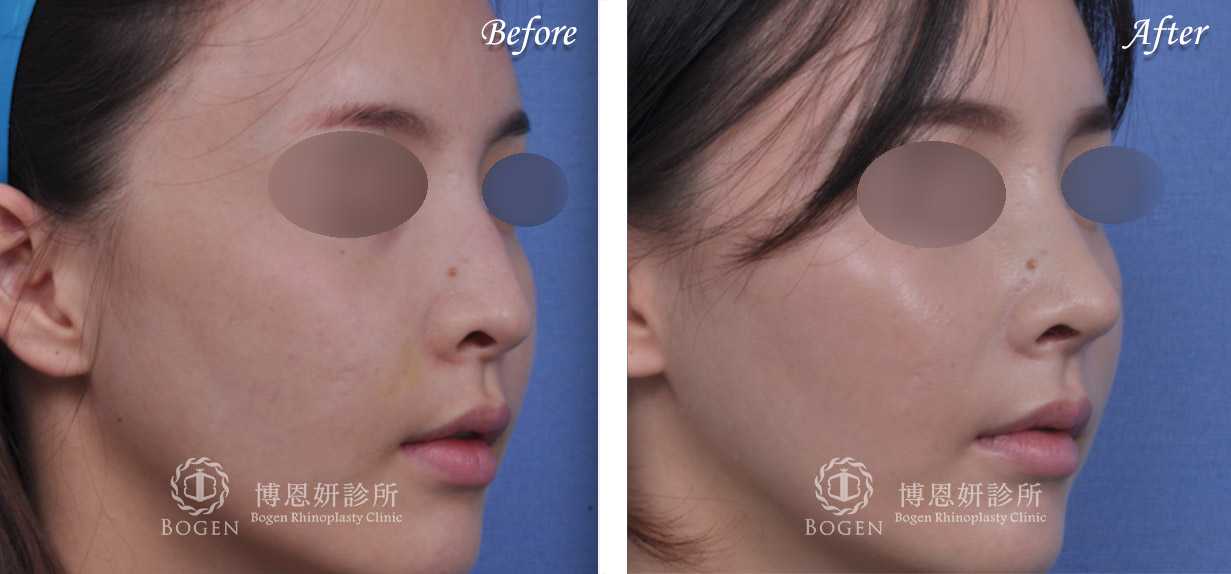 鼻整形術前術後照鼻整形案例14,鼻整形手術推薦博恩妍診所張簡醫師