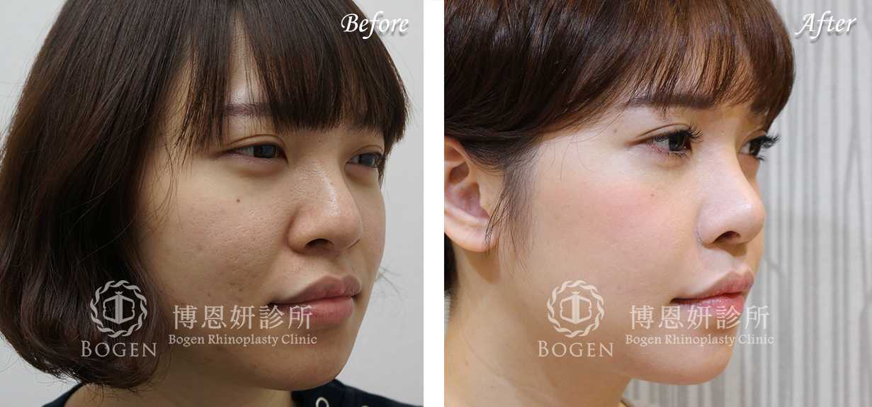 鼻整形術前術後照鼻整形案例06,鼻整形手術推薦博恩妍診所張簡醫師