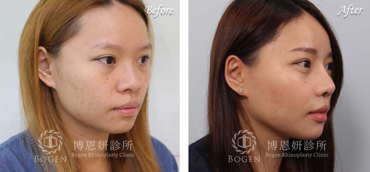 鼻整形術前術後照鼻整形案例9,鼻整形手術推薦博恩妍診所張簡醫師