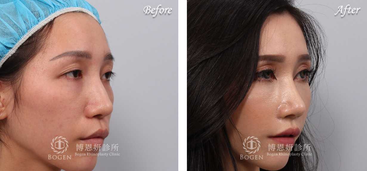 鼻整形術前術後照鼻整形案例12,鼻整形手術推薦博恩妍診所張簡醫師