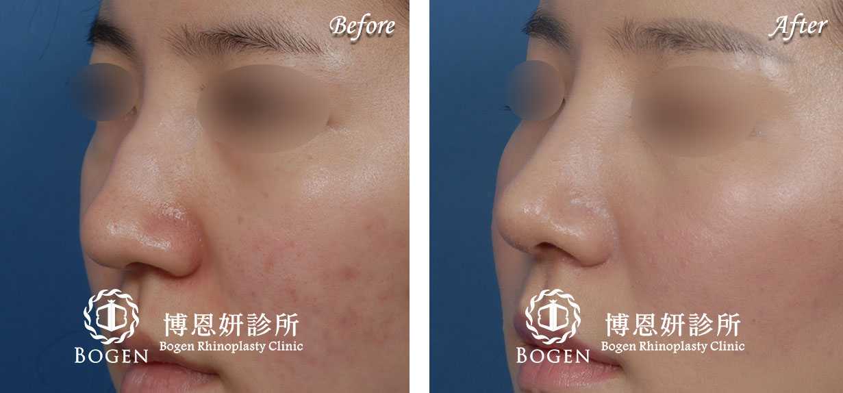 鼻整形術前術後照鼻整形案例13,鼻整形手術推薦博恩妍診所張簡醫師