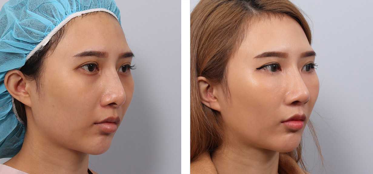 鼻整形術前術後照鼻整形案例17,鼻整形手術推薦博恩妍診所張簡醫師