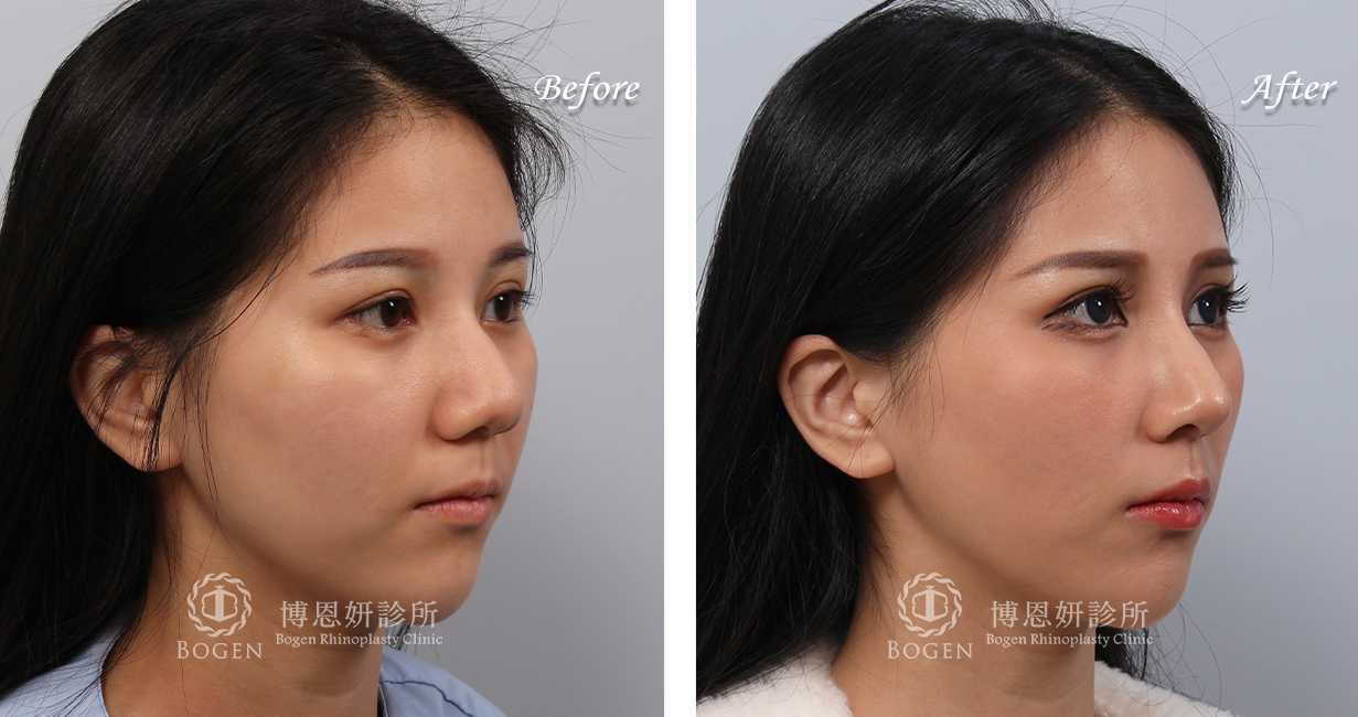 隆鼻分享手術前後照片比對案例,隆鼻手術推薦張簡醫師
