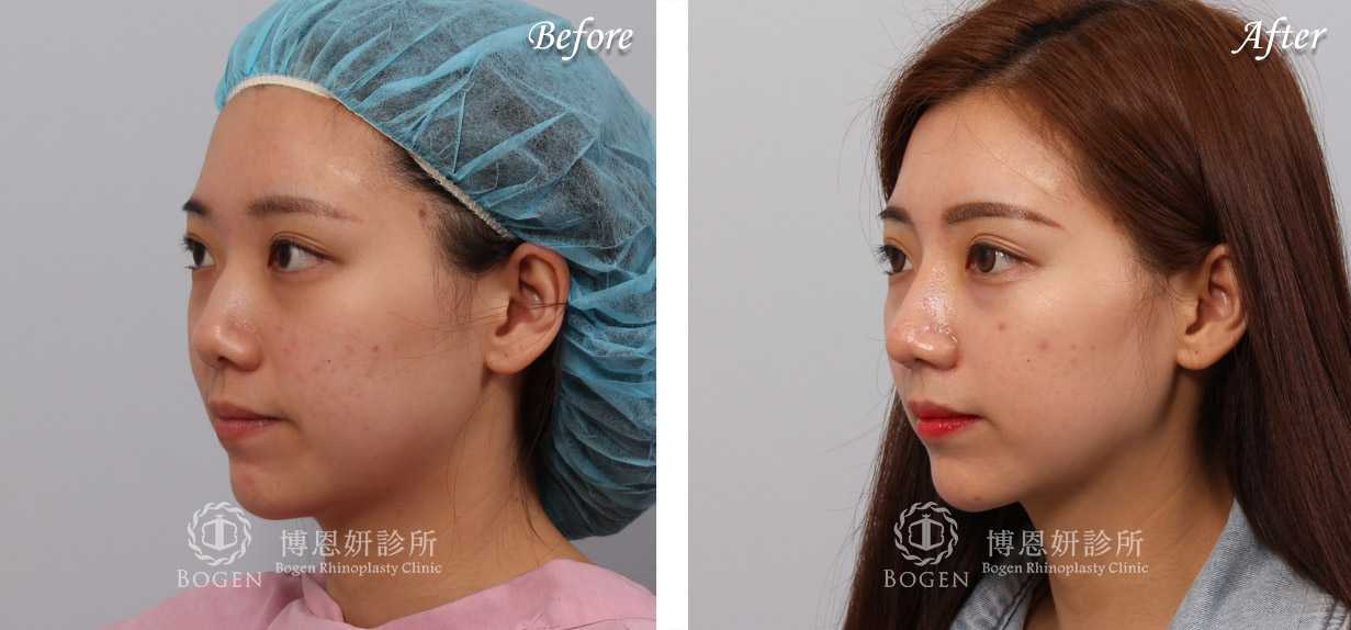 鼻整形術前術後照鼻整形案例19,鼻整形手術推薦博恩妍診所張簡醫師