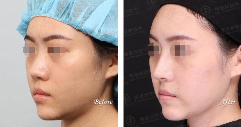 Fitme完形美客製化隆鼻案例一