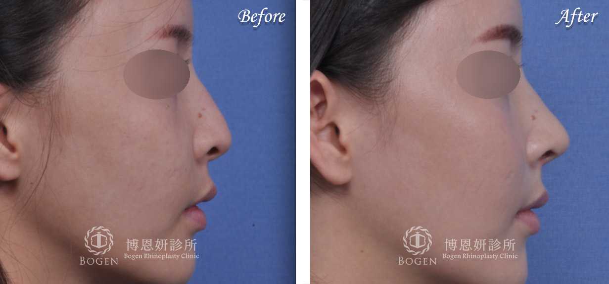 鼻整形術前術後照鼻整形案例14,鼻整形手術推薦博恩妍診所張簡醫師