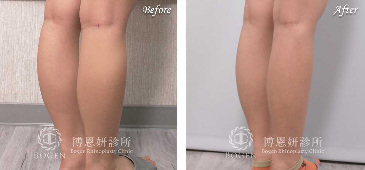 小腿抽脂改善脂肪堆積問題