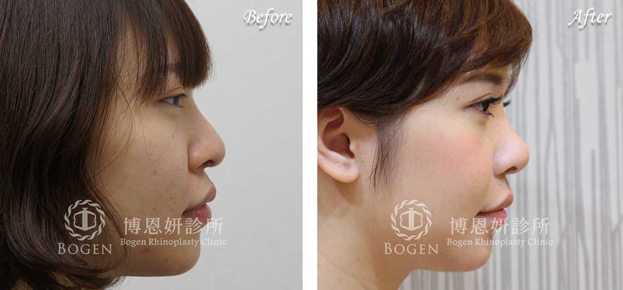 鼻整形術前術後照鼻整形案例06,鼻整形手術推薦博恩妍診所張簡醫師