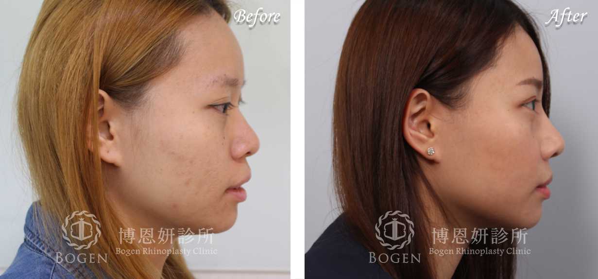 鼻整形術前術後照鼻整形案例9,鼻整形手術推薦博恩妍診所張簡醫師