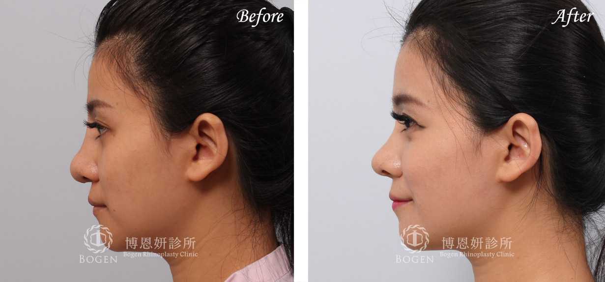 鼻整形術前術後照鼻整形案例10,鼻整形手術推薦博恩妍診所張簡醫師