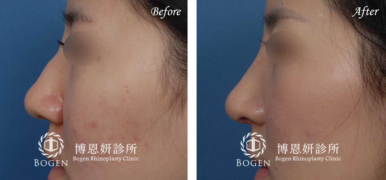 鼻整形術前術後照鼻整形案例13,鼻整形手術推薦博恩妍診所張簡醫師
