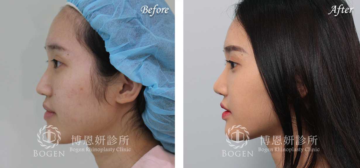 鼻整形術前術後照鼻整形案例16,鼻整形手術推薦博恩妍診所張簡醫師