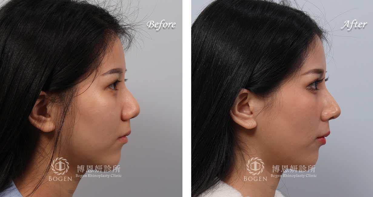 隆鼻分享手術前後照片比對案例,隆鼻手術推薦張簡醫師
