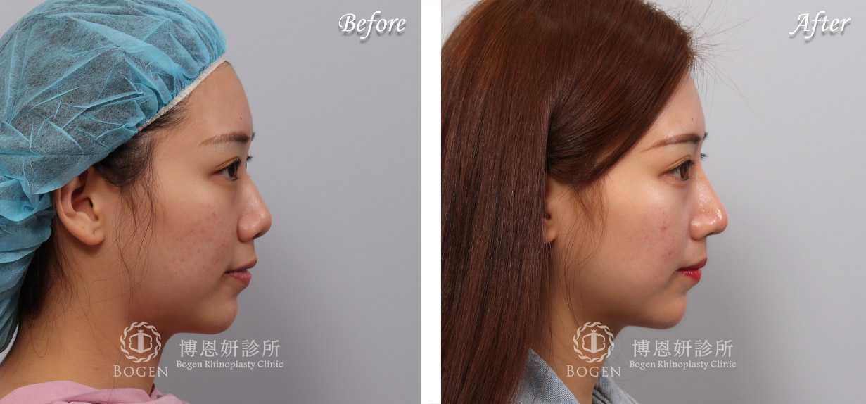 鼻整形術前術後照鼻整形案例19,鼻整形手術推薦博恩妍診所張簡醫師
