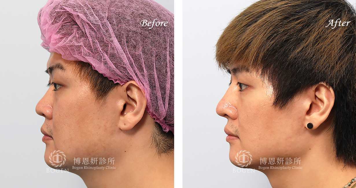 男性鼻整形術前術後照鼻整形案例20,鼻整形手術推薦博恩妍診所張簡醫師