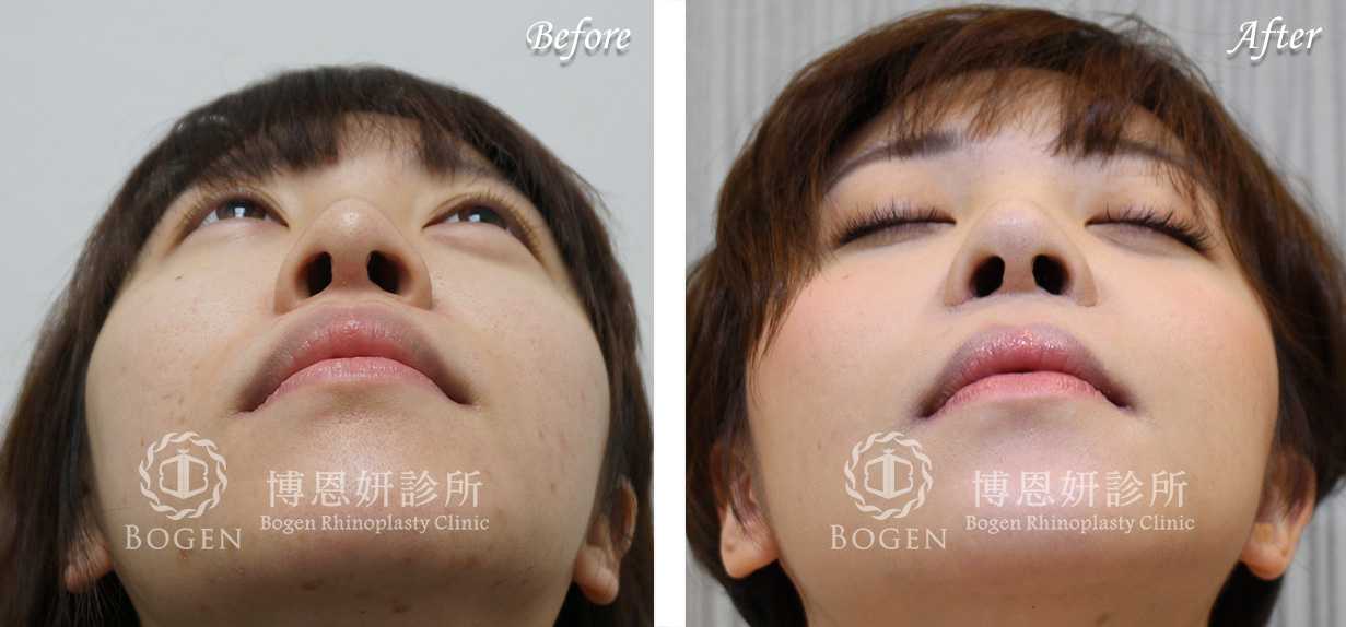 鼻整形術前術後照鼻整形案例06,鼻整形手術推薦博恩妍診所張簡醫師