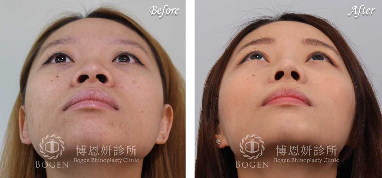 鼻整形術前術後照鼻整形案例9,鼻整形手術推薦博恩妍診所張簡醫師
