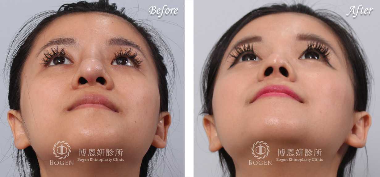 鼻整形術前術後照鼻整形案例10,鼻整形手術推薦博恩妍診所張簡醫師