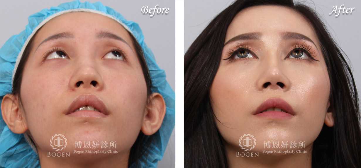 鼻整形術前術後照鼻整形案例12,鼻整形手術推薦博恩妍診所張簡醫師