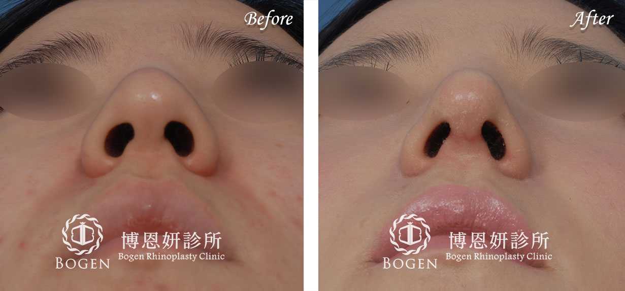 鼻整形術前術後照鼻整形案例13,鼻整形手術推薦博恩妍診所張簡醫師
