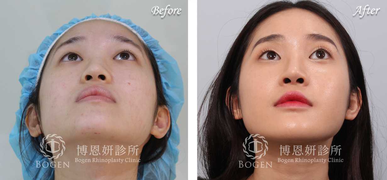 鼻整形術前術後照鼻整形案例16,鼻整形手術推薦博恩妍診所張簡醫師