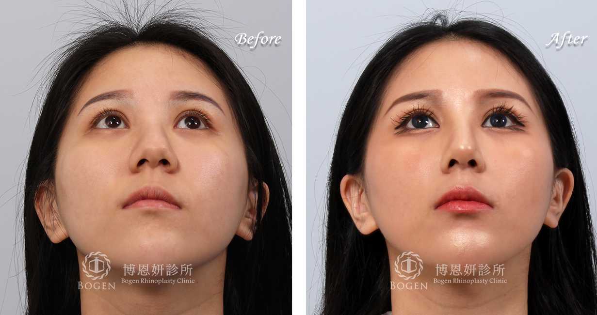 隆鼻分享手術前後照片比對案例,隆鼻手術推薦張簡醫師
