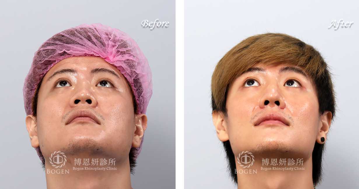 男性鼻整形術前術後照鼻整形案例20,鼻整形手術推薦博恩妍診所張簡醫師