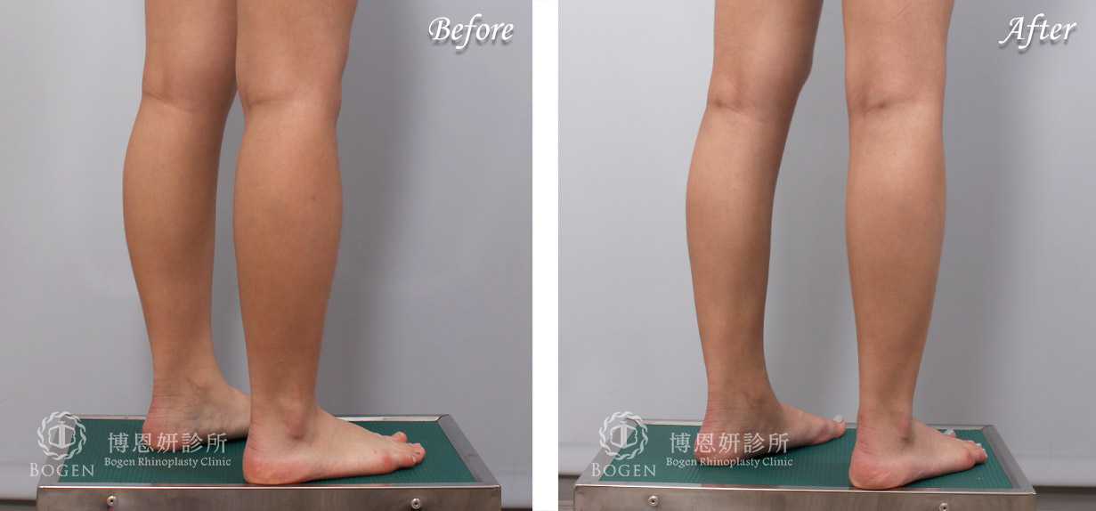 小腿抽脂改善脂肪堆積問題