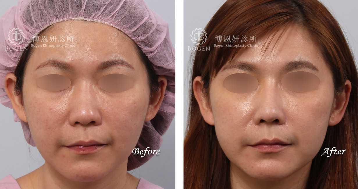 鼻整形術前術後照鼻整形案例18,鼻整形手術推薦博恩妍診所張簡醫師