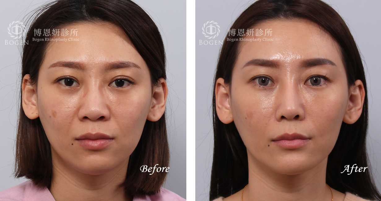 張簡醫師縮鼻翼權威，縮鼻翼術前術後照片
