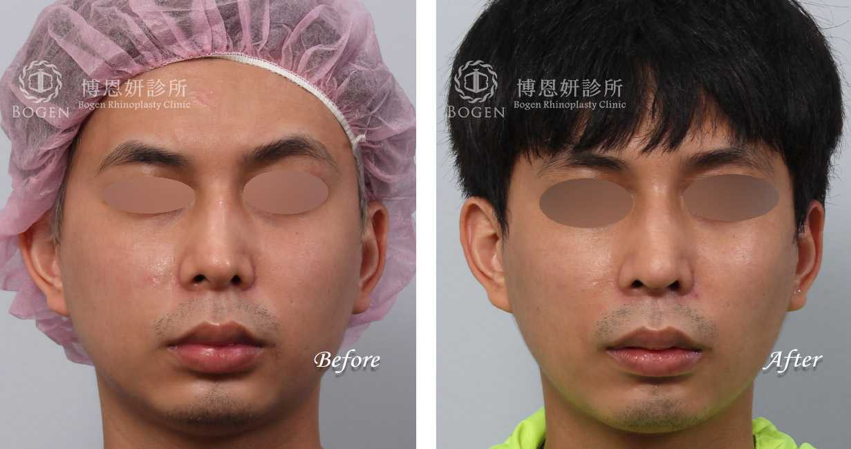 男鼻整形,隆鼻男性,鼻整形無假體異體真皮隆鼻,縮鼻翼鼻整形,海鷗線鼻整形