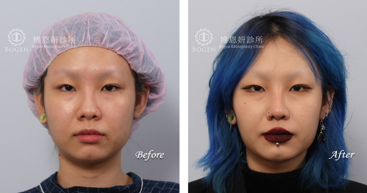 鼻整形術前術後照鼻整形案例22,鼻整形手術推薦博恩妍診所張簡醫師
