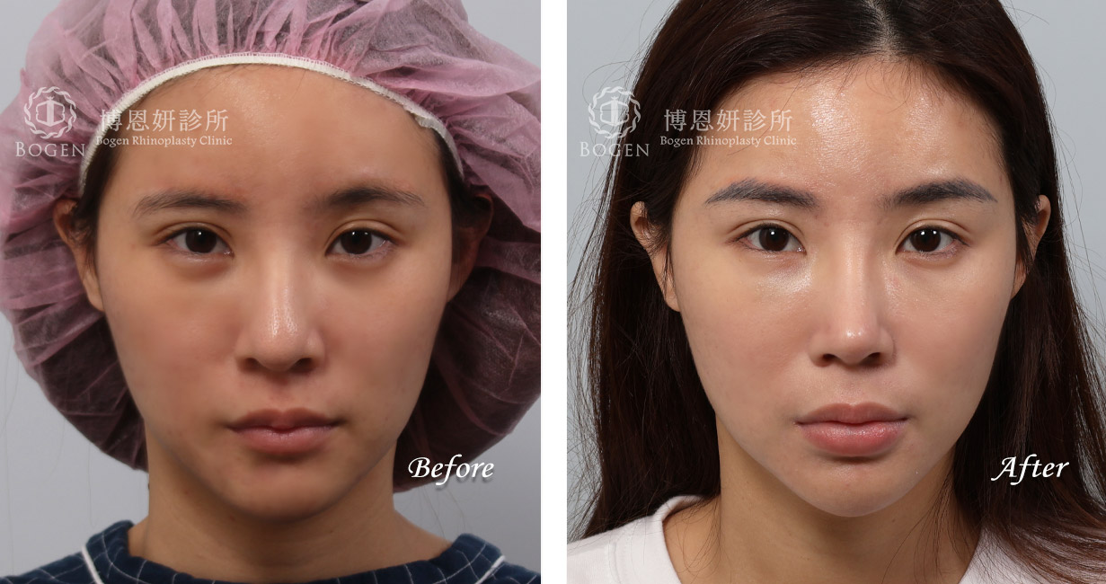 隆鼻手術案例,博恩妍診所隆鼻手術術前術後照,隆鼻推薦張簡醫師
