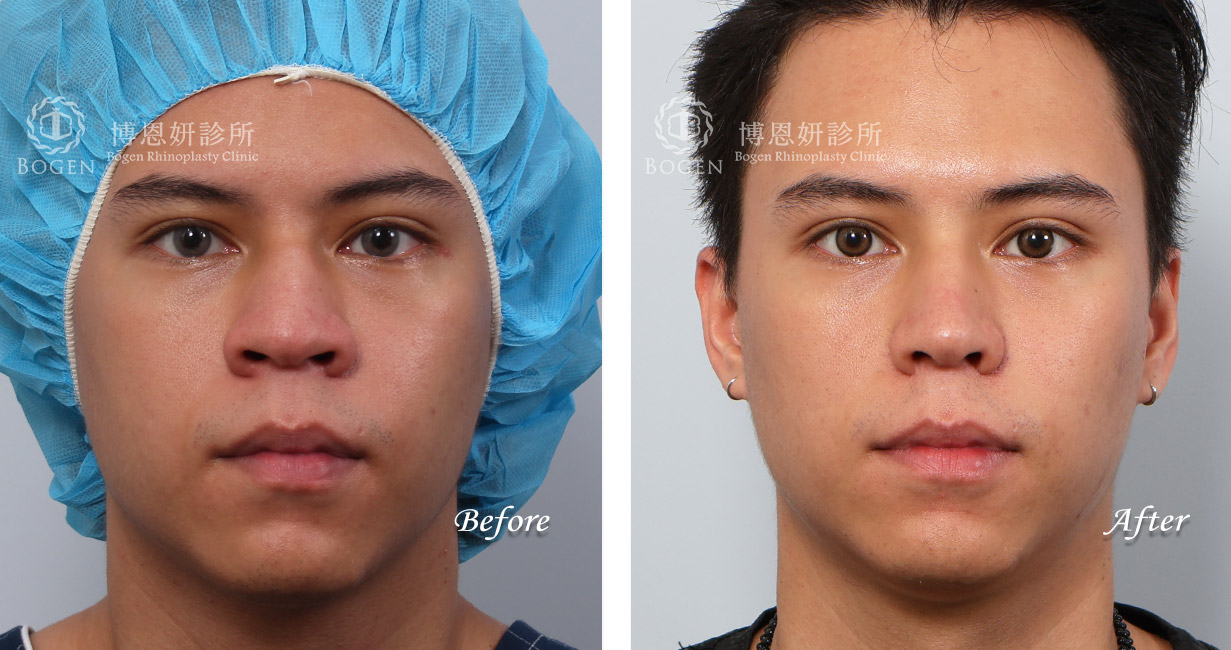 縮鼻翼推薦,男性隆鼻,無假體異體真皮隆鼻,縮鼻翼,海鷗線,張簡醫師縮鼻翼權威