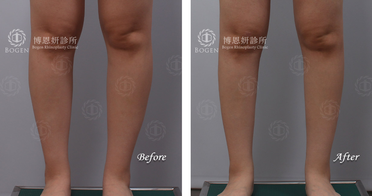 小腿抽脂改善脂肪堆積問題